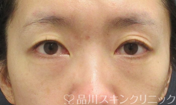 症例NO.68717のBEFORE写真