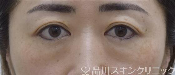 症例NO.53186のBEFORE写真