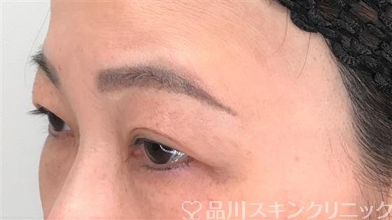 症例NO.58507のBEFORE写真