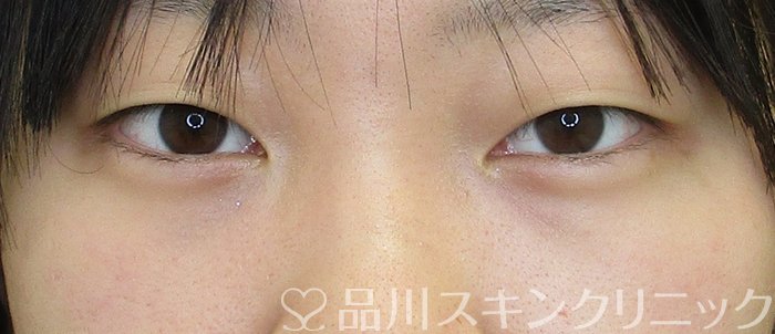 症例NO.68112のBEFORE写真