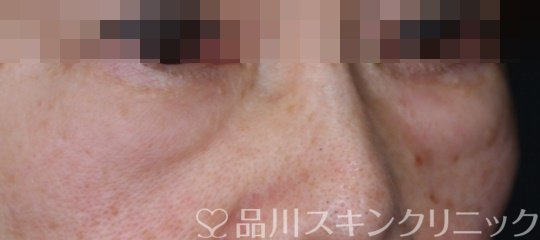 症例NO.64355のBEFORE写真