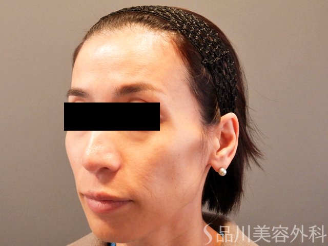 症例NO.67278のBEFORE写真