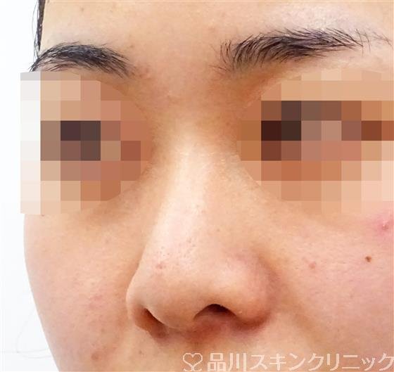 症例NO.45913のBEFORE写真