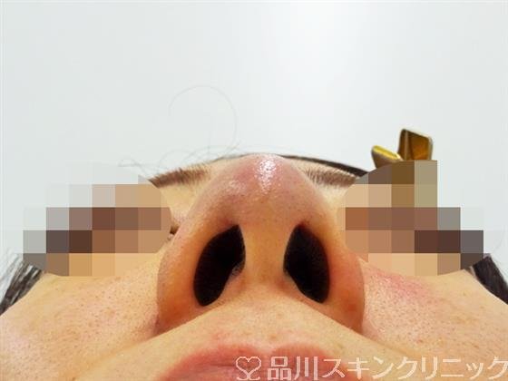 症例NO.48793のAFTER写真