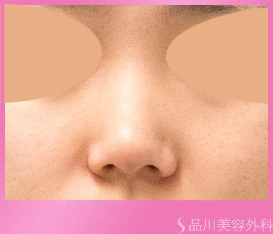 症例NO.22239のBEFORE写真