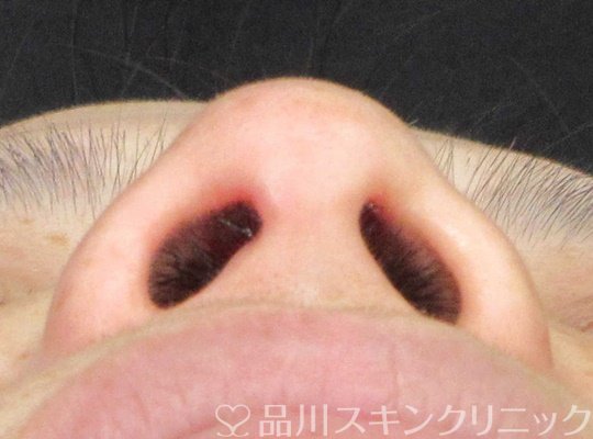 症例NO.67485のBEFORE写真