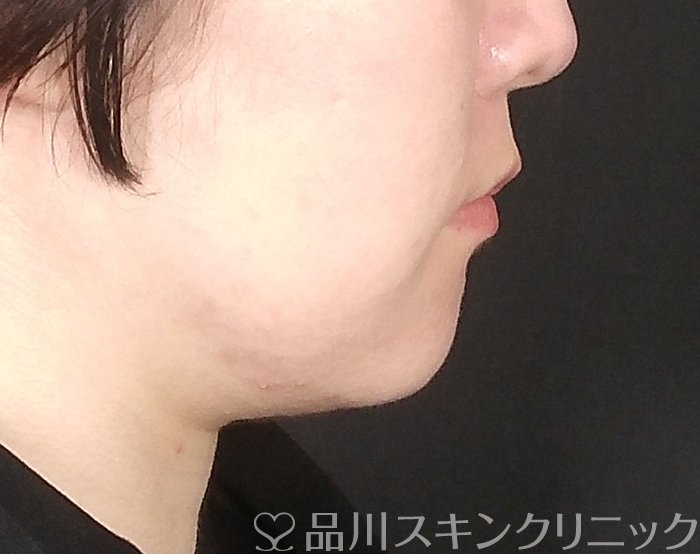 症例NO.63977のBEFORE写真