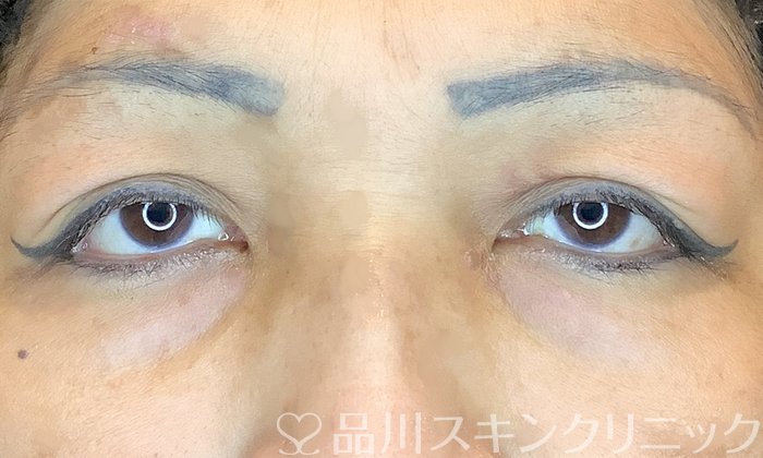 症例NO.68224のBEFORE写真