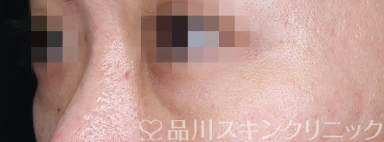 症例NO.68456のBEFORE写真