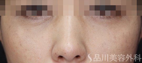 症例NO.66455のAFTER写真