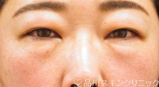 症例NO.52707のBEFORE写真