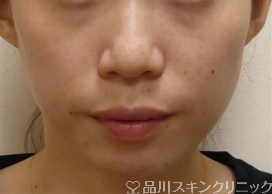 症例NO.32237のBEFORE写真