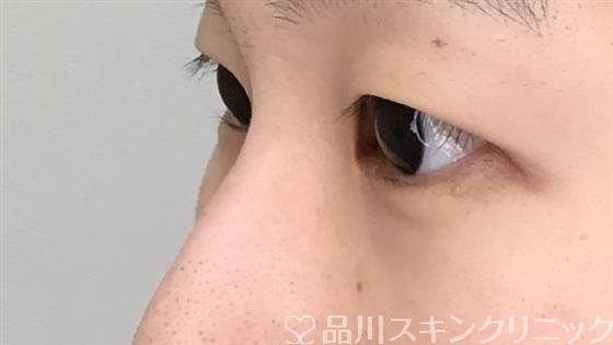 症例NO.52363のBEFORE写真