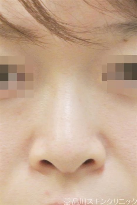 症例NO.42310のBEFORE写真