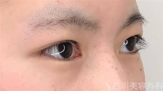 症例NO.60245のBEFORE写真