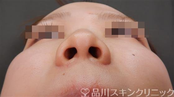 症例NO.56326のBEFORE写真