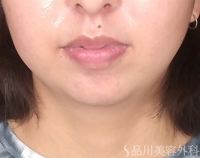 症例NO.65687のBEFORE写真