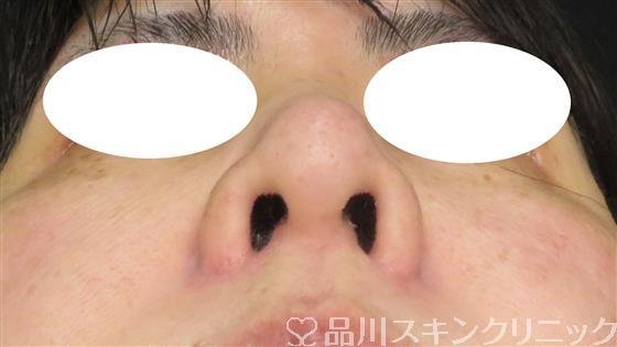 症例NO.51200のBEFORE写真