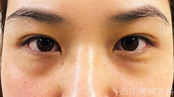 症例NO.21587のBEFORE写真