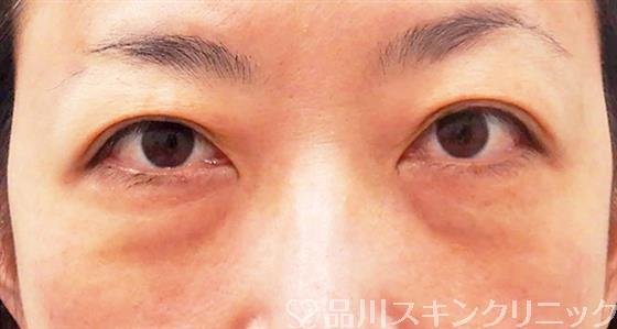 症例NO.60498のBEFORE写真