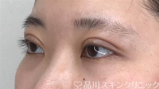 症例NO.57313のBEFORE写真