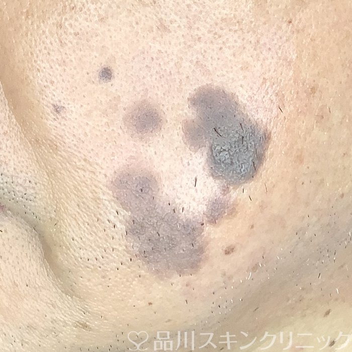 症例NO.66186のBEFORE写真