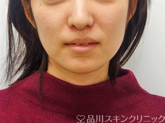 症例NO.48938のBEFORE写真