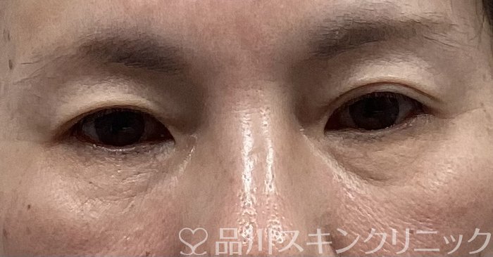 症例NO.68153のBEFORE写真