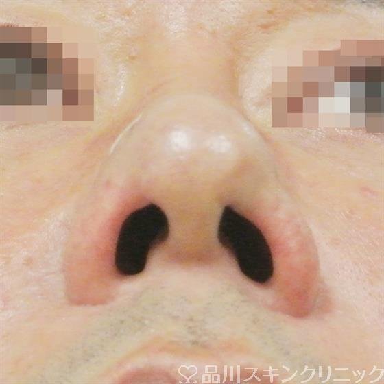 症例NO.36386のAFTER写真