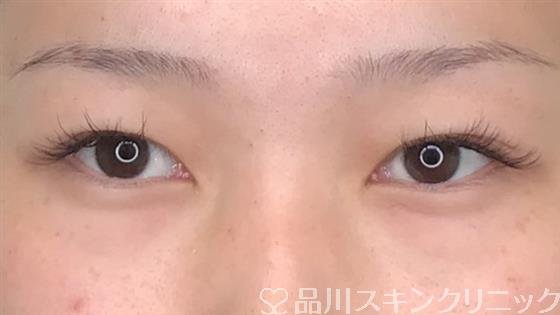 症例NO.58582のBEFORE写真