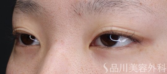 症例NO.69096のBEFORE写真