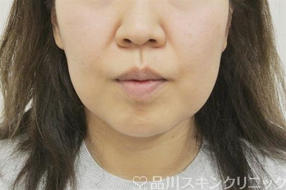 症例NO.40545のBEFORE写真