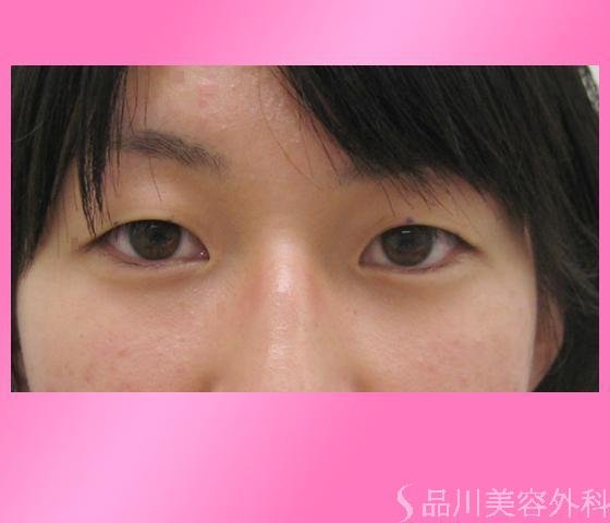 症例NO.3368のBEFORE写真