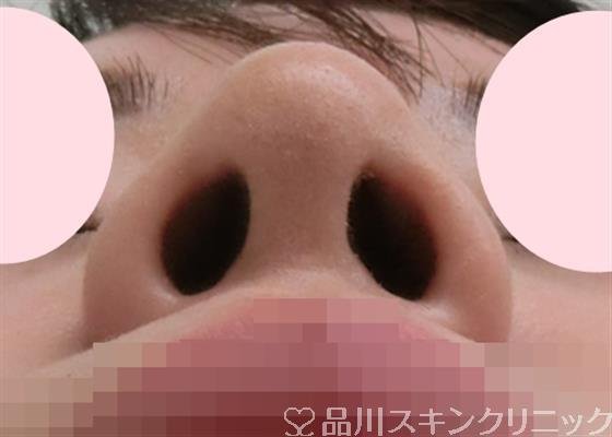 症例NO.28580のAFTER写真