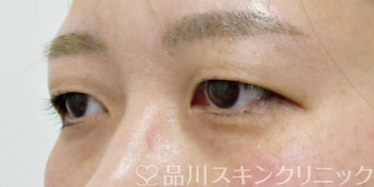 症例NO.69196のBEFORE写真