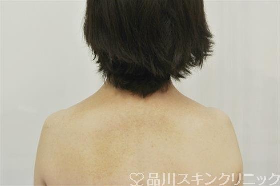 症例NO.41116のAFTER写真