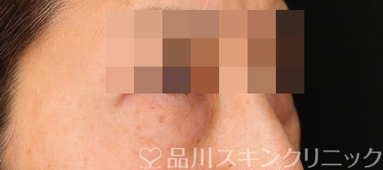 症例NO.66316のBEFORE写真