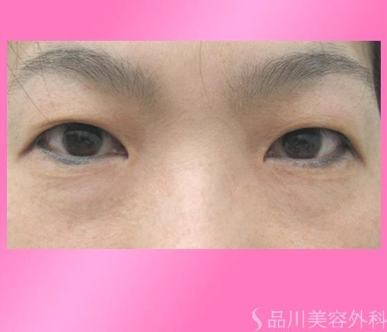 症例NO.1752のBEFORE写真