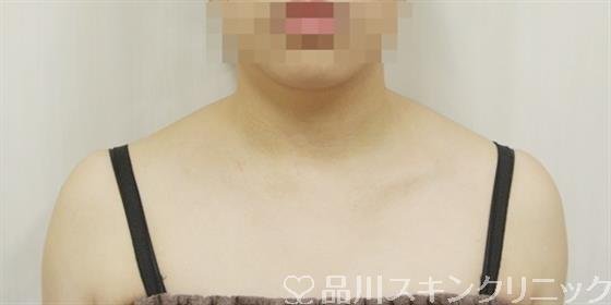 症例NO.29757のBEFORE写真