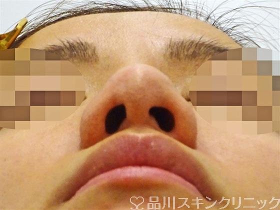 症例NO.47117のBEFORE写真