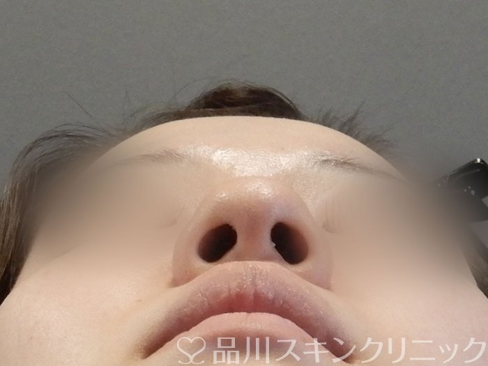 症例NO.65584のBEFORE写真