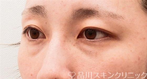 症例NO.61488のBEFORE写真