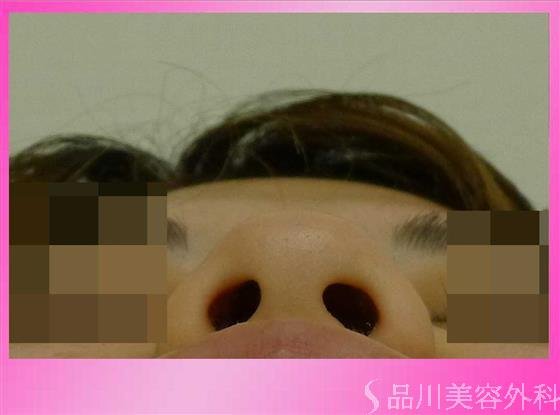 症例NO.33872のBEFORE写真