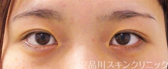 症例NO.53207のBEFORE写真