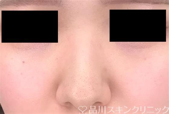 症例NO.54953のBEFORE写真