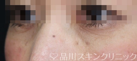 症例NO.65560のAFTER写真