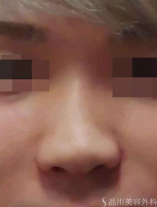 症例NO.40147のBEFORE写真