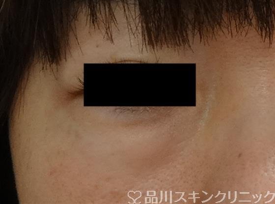 症例NO.45274のBEFORE写真