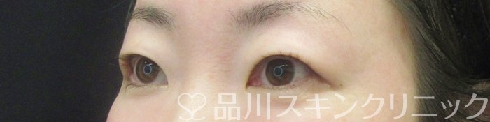 症例NO.68028のBEFORE写真