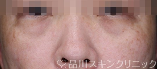 症例NO.65836のBEFORE写真